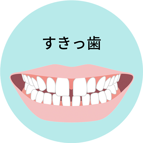 すきっ歯