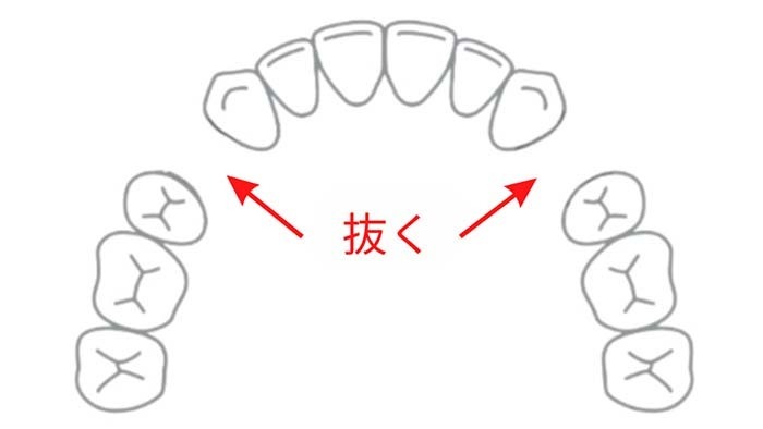静岡県浜松市で抜歯の歯列矯正