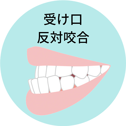 受け口