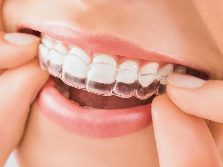 静岡県浜松市の痛みの少ない安いインビザライン