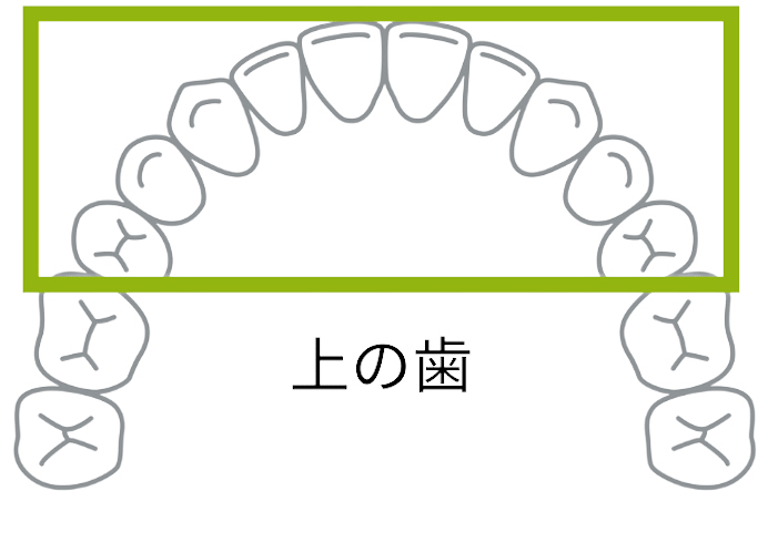 スペース確保に失敗するとインビザラインで後悔します