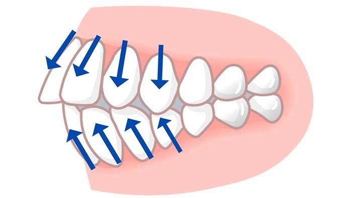 歯が外側に飛び出すイメージ