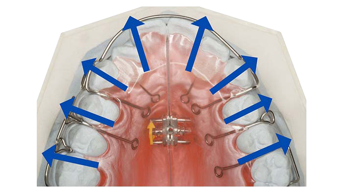 拡大床で失敗するとインビザラインに後悔することに・・