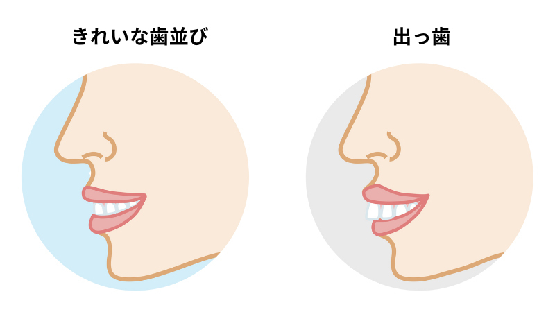 きれいな歯並びと出っ歯の比較