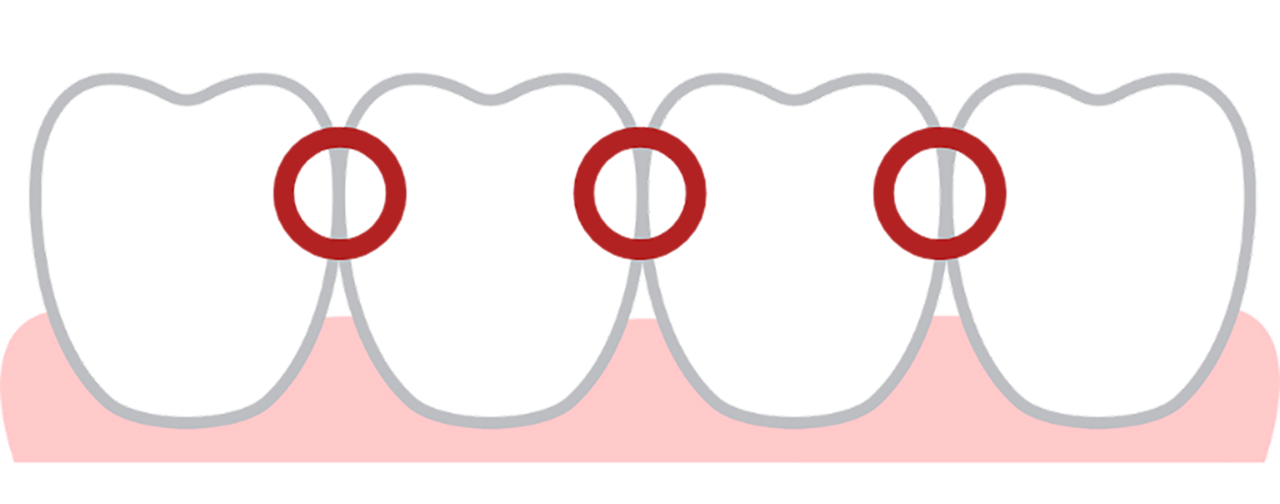 IPRで失敗するとインビザラインに後悔することに・・