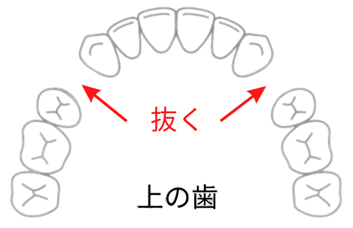 不要な抜歯はインビザラインで後悔します