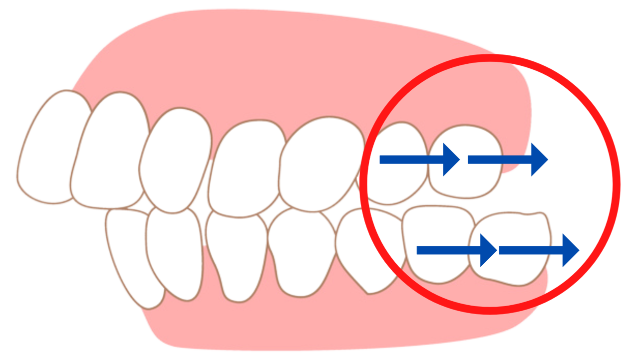 奥歯をインビザラインで動かせば後悔しません