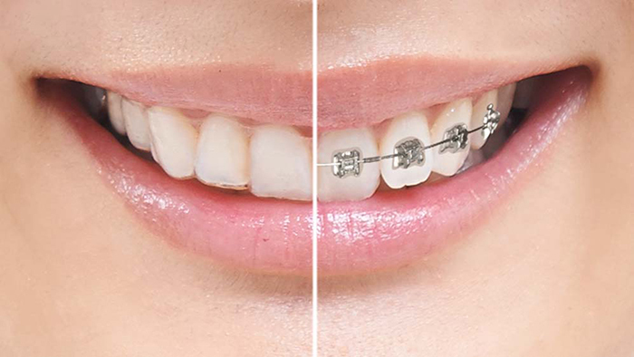 静岡県浜松市の透明で目立たない安いインビザライン