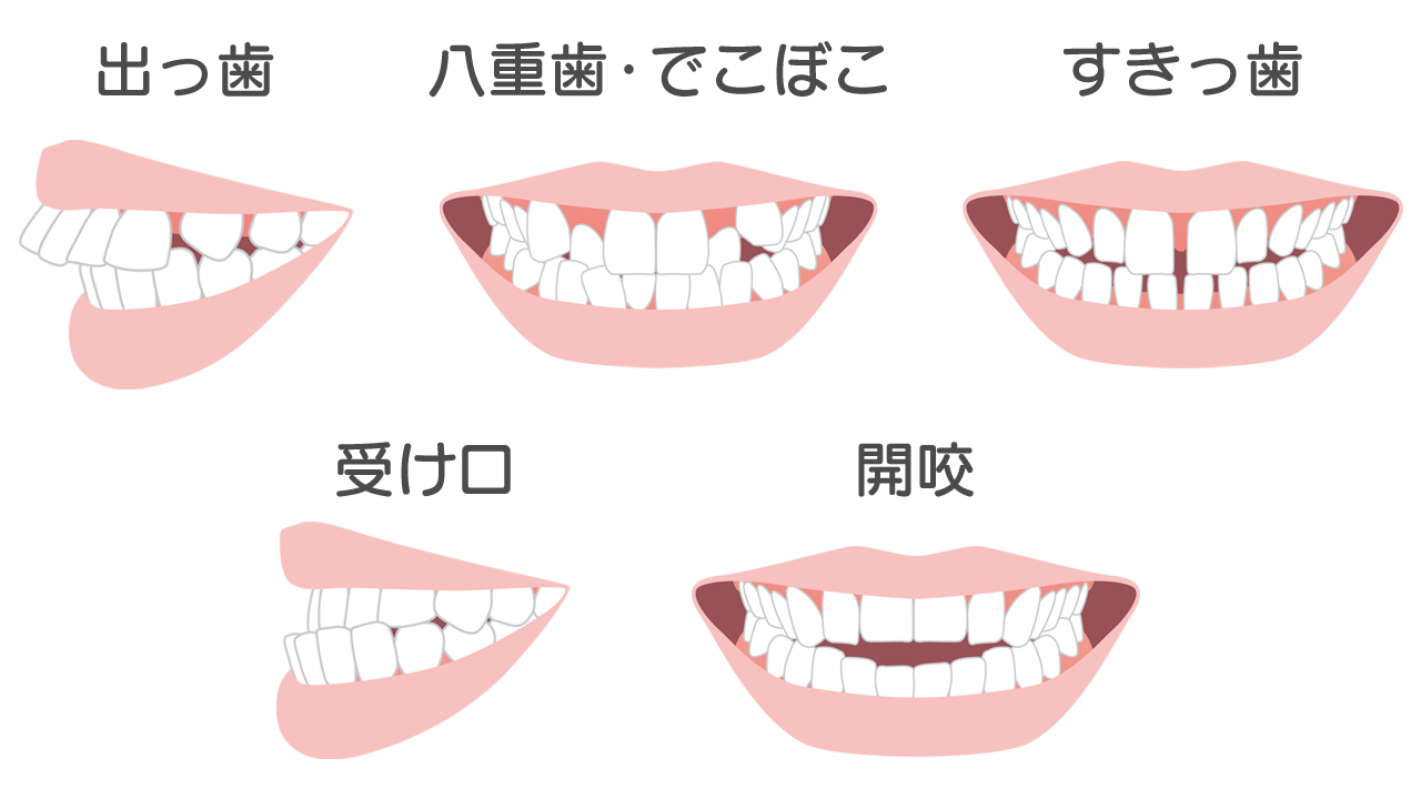 様々な歯並びの症状