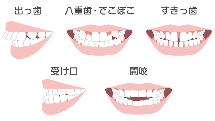 マウスピース矯正ができない症例でも失敗しないために - 浜松市矯正歯科相談室
