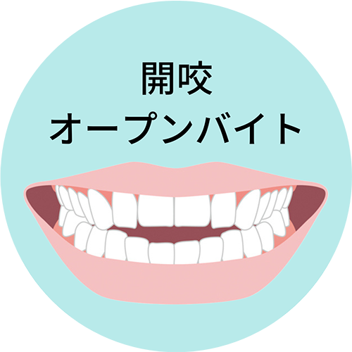 開咬