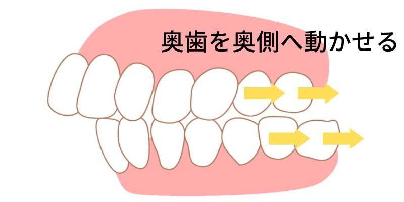 インビザラインは奥歯を動かせる - 浜松市矯正歯科相談室