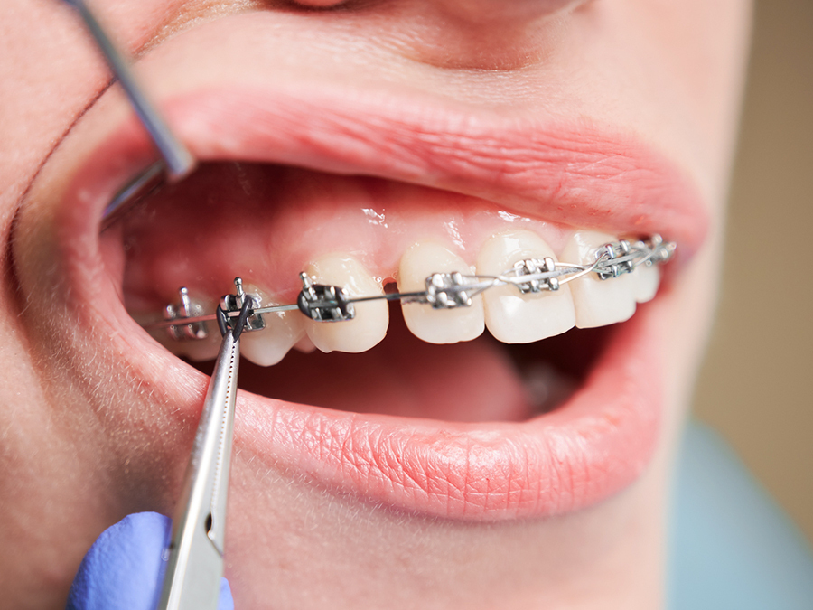 静岡県浜松市の従来の矯正