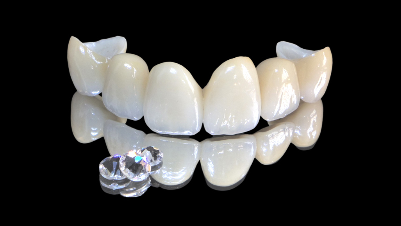 おすすめの安いセラミック矯正の値段と費用 - 浜松市矯正歯科相談室