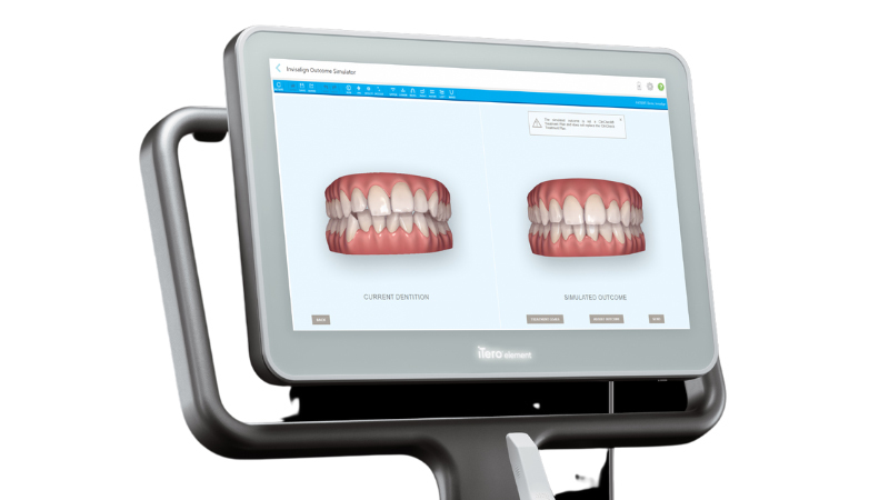 AIによる矯正シミュレーション