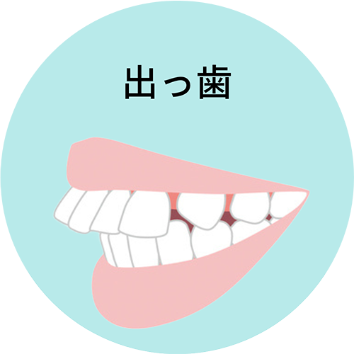 出っ歯