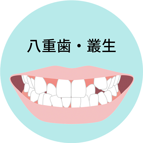 八重歯・叢生