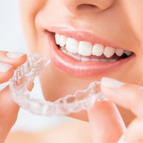 静岡県浜松市の軽度な歯並び矯正